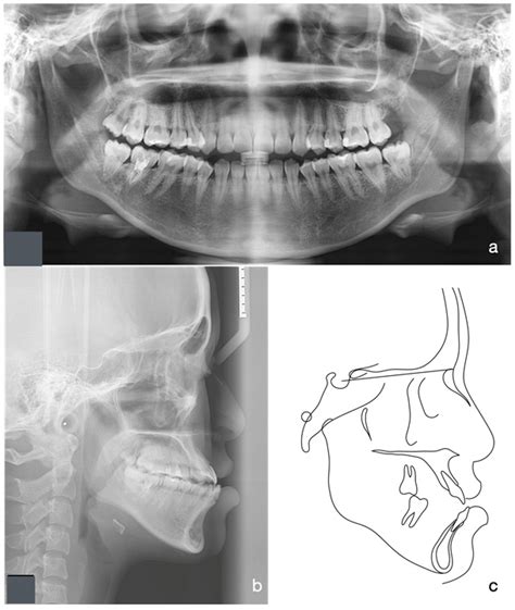 Management of Class III Malocclusion with Microimplant-Assisted Rapid ...