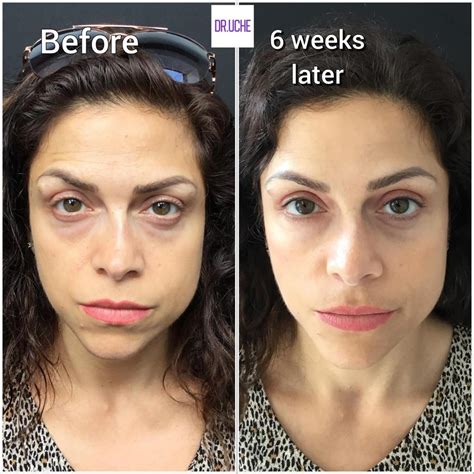 POLYNUCLEOTIDES | Cosmetic treatments in Sidcup by GSN Aesthetics