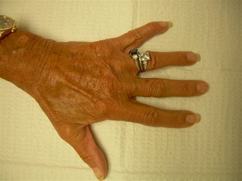 Image result for Hand Dysfunction