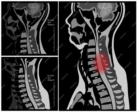 Premium Vector | Mri of the cervical spine with and without contrast, mri with bilateral c7 root ...