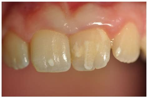 Kuvatulokset haulle celiac dental