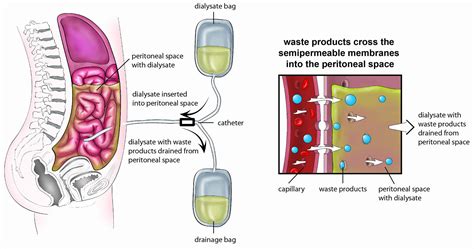 Image result for Dialysis Procedure Step by Step