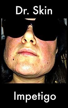 Impetigo eBook : Skin, Dr.: Amazon.in: Kindle Store