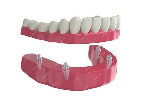 Dental prosthesis, 4 overdenture implants, lower arch, 3d render ...