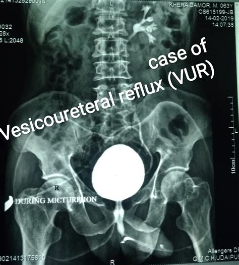 Vcug Medical Abbreviation