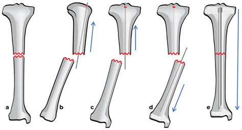 Tips and Tricks for Installation of the SLIM Nail in Osteogenesis ...