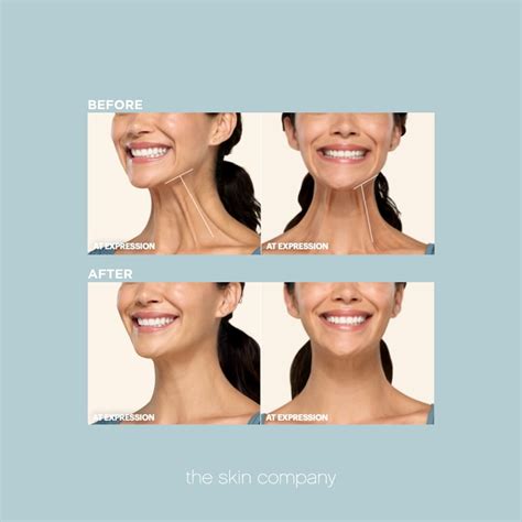 Sore Jaw After Masseter Botox: How Long It Lasts
