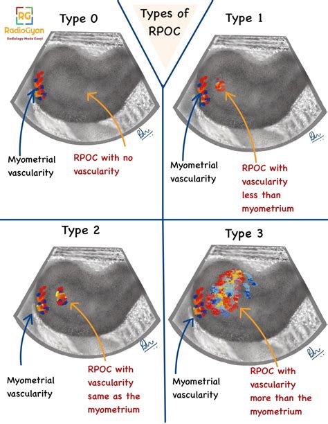 Retained Products Of Conception | Radiology Case | - RadioGyan