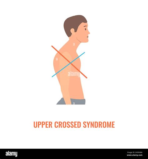 Upper crossed syndrome, conceptual illustration Stock Photo - Alamy