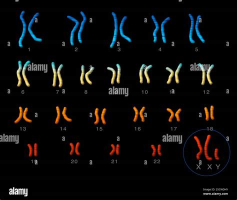 Klinefelter syndrome karyotype hi-res stock photography and images - Alamy
