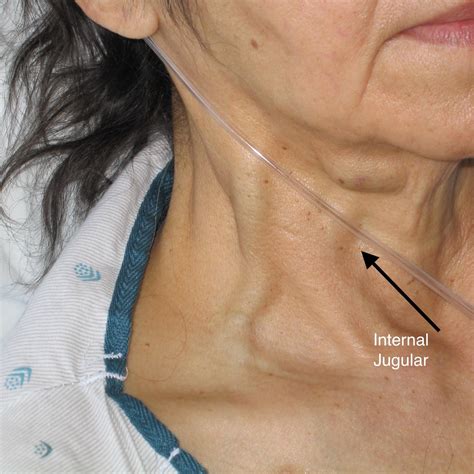 Congestive Heart Failure | SAEM