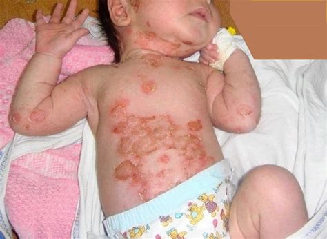 Impetigo contagiosa, causes, symptoms, diagnosis, treatment & prognosis