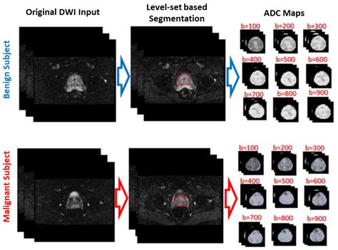 Precise Identification of Prostate Cancer from DWI Using Transfer Learning