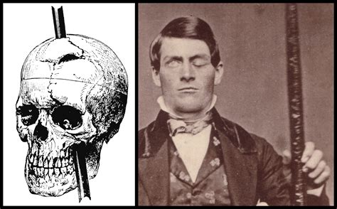 Phineas Gage (Brain Trauma Survivor) ~ Bio Wiki | Photos | Videos