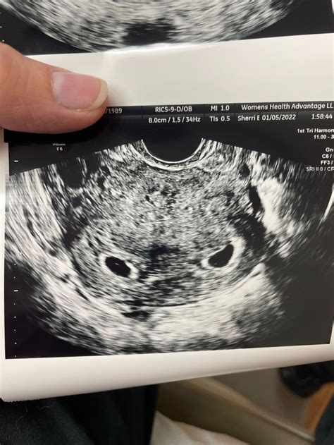 Printable Ultrasound Pics Of 5 Week Twins