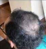 Buy Anti Bald Hair Oil - Reduce Patches & Encourage Hair Regeneration