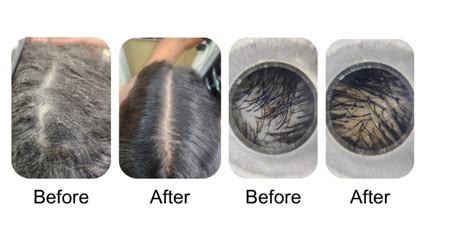 Dandruff Treatment Kit – Hairmac