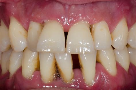 Severe Gum Disease