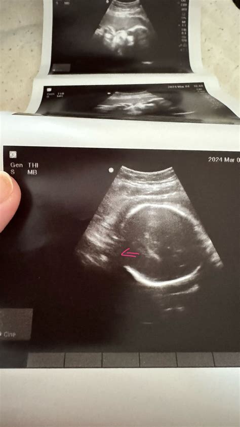 32 weeks + 5 days ultrasound | BabyCenter