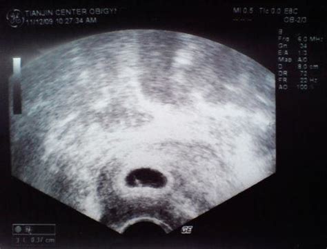 一张详情图看懂胎儿从受精卵到足月出生变化__凤凰网