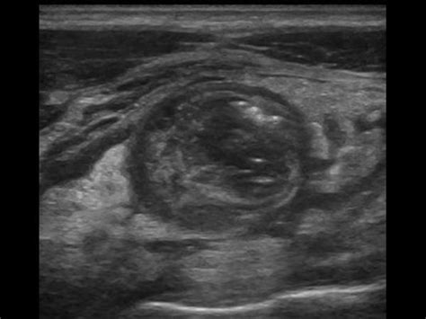 Image result for Perforated Appendix