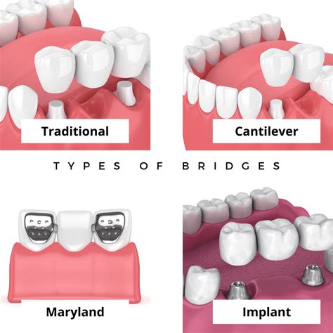 Crowns and Bridges Treatment | 3D Dentistry in Bradenton, FL