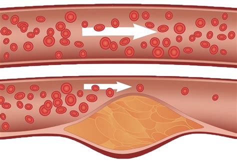 Hyperlipidemia