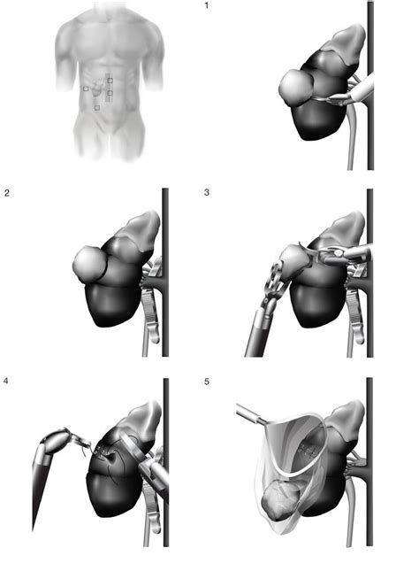 Image result for Steps of Partial Nephrectomy