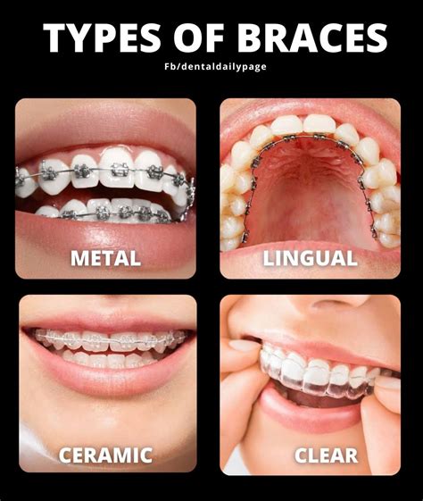 Types of braces | Dental braces, Types of braces, Dental clip