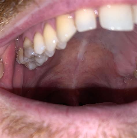 Image result for Grey Tooth