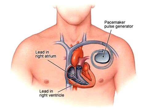 Image result for Installing Pacemaker