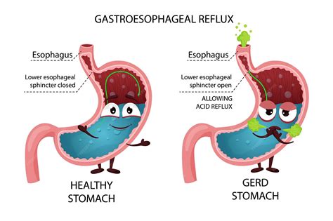 Premium Vector | Happy healthy stomach and sick gastroesophageal reflux disease gerd cartoon ...