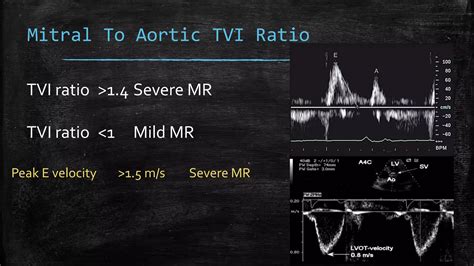Echocardiography of Mitral regurgitation | PPTX