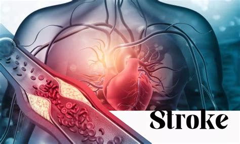 Elective Surgery within 1 year of an ACS or stroke associated with ...