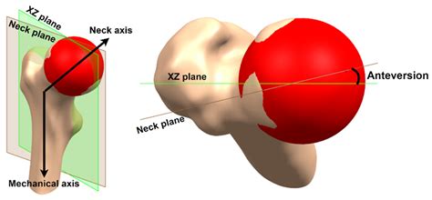 Innovative Design Methodology for Patient-Specific Short Femoral Stems