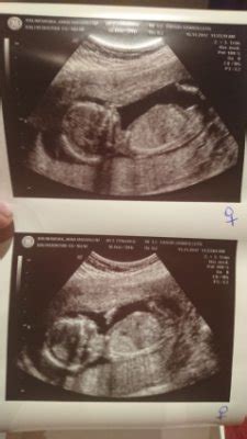 Bebés gemelar | BabyCenter