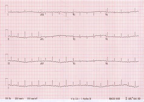 Cardiac Tamponade