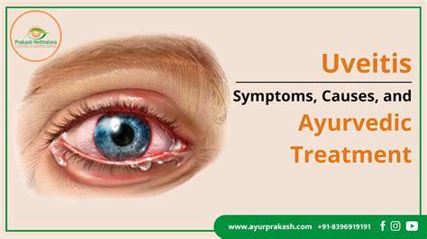 Uveitis Causes Uveitis Treatment Fitchburg MA Uveitis Surgery West