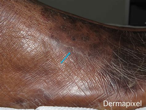 Dermapixel: No todas las tiñas del pie son tiñas pedis