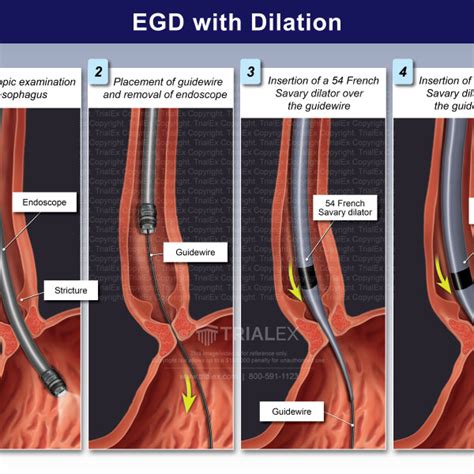 Image result for EDG Procedures