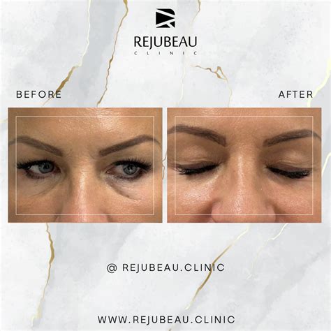 HOW TO FIX TIRED EYES WITH UNDER EYE FILLERS - Rejubeau Clinic | Filler | Botox | Sculptra