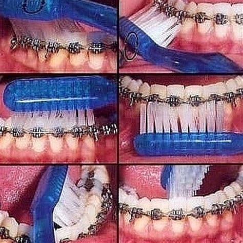 Toothbrushes with chains used as dental tools for teeth | Braces ...