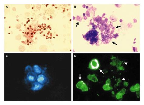 Image result for Opportunistic Pathogen