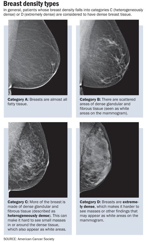 Normal Mammogram Dense Tissue