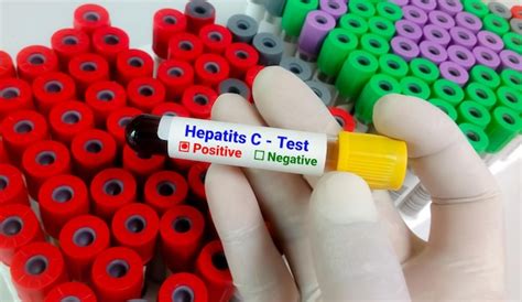 Hep C Test 的图像结果