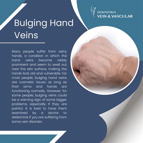 Visible Hand Veins and Why You Have Them