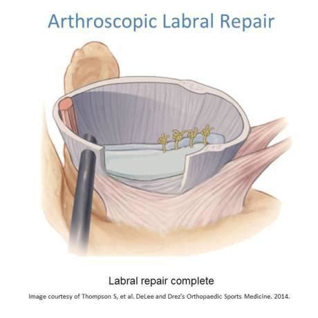 Image result for Shoulder Labral Tear Surgery