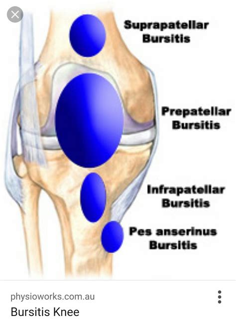 What Causes Bursitis Knee : Knee bursitis – WYLS