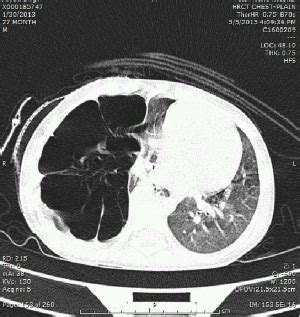 Unilateral cystic lung lesions | Pediatric Oncall Journal