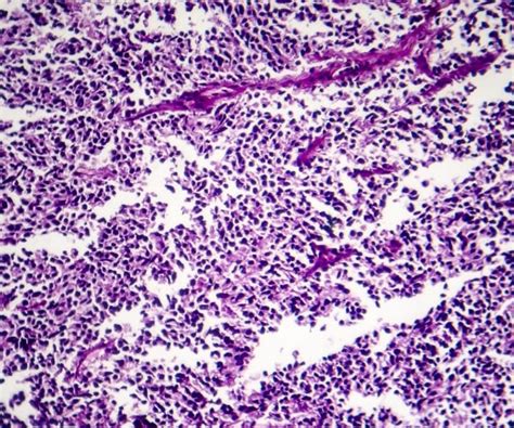 FDA Approves Amgen Drug for Small Cell Lung Cancer | Newsmax.com